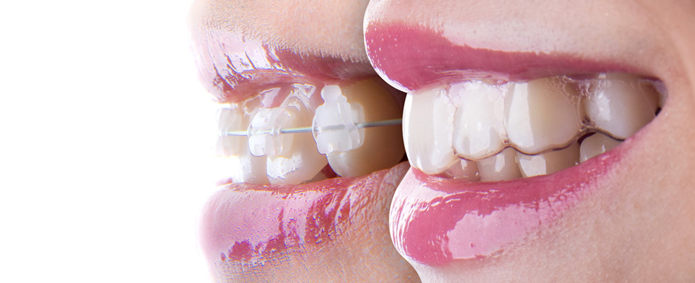 Invisalign Clearsmile